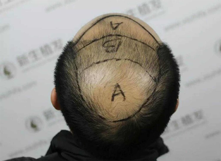 Nam thanh niên được xác định vùng tóc cấy trước khi bước vào ca phẫu thuật tại một bệnh viện ở Bắc Kinh, Trung Quốc. Ảnh: Baidu.