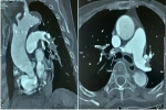 Thuyên tắc động mạch phổi hậu Covid-19