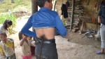 Người mọc đuôi ở Hà Giang: Vừa cắt đuôi thì lăn ra... ốm