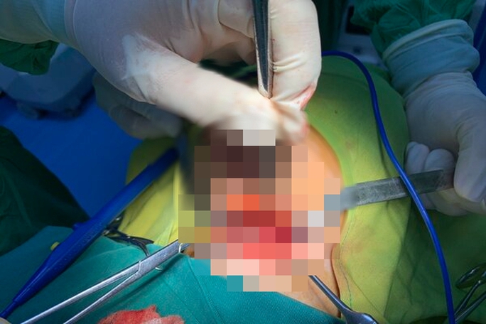 Các bác sĩ thực hiện phương pháp gây mê đặt nội khí quản để cắt khối u cho bệnh nhân. (Ảnh: Bệnh viện cung cấp).