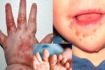 Trẻ có thể bị tay chân miệng và sốt xuất huyết cùng lúc không? Phân biệt vết loét do tay chân miệng gây ra