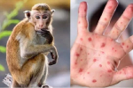 Hà Nội hướng dẫn chẩn đoán, điều trị và phòng bệnh đậu mùa khỉ