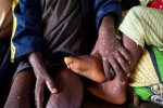 Châu Phi công bố 103 ca tử vong do đậu mùa khỉ, cảnh báo đường lây khác