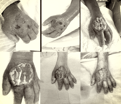 Bàn tay bị hoại tử của bệnh nhân. Ảnh: BSCC.