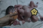 Bác sĩ Trung Quốc cứu bé trai 4 tay 4 chân bị bào thai ký sinh đeo bám