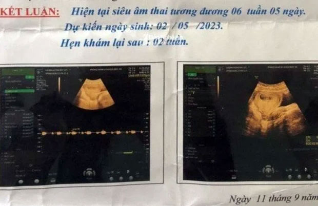 Hình ảnh siêu âm thai nhi của cháu bé. Ảnh chụp màn hình