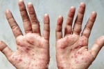 Phát hiện ca đậu mùa khỉ đầu tiên, 6 khuyến cáo phòng bệnh