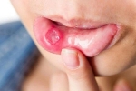 Tưởng bị nhiệt miệng, người đàn ông bàng hoàng phát hiện mắc ung thư lưỡi: Phân biệt thế nào?