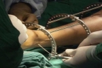 Cô gái 19 tuổi trả giá đắt khi làm phẫu thuật kéo dài chân