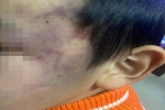 Vụ bé trai 4 tuổi bị bầm tím mặt: Công an tiết lộ bất ngờ