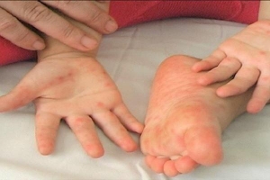 Một cháu bé tử vong vì bệnh tay chân miệng