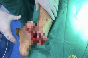 Bác sĩ xuyên đêm nối bàn chân người đàn ông bị cưa máy cắt đứt lìa