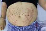 Người đàn ông ở Hà Nội nhập viện do để ong châm chữa bệnh