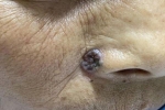 Tưởng là nốt ruồi bình thường, đi khám người phụ nữ tá hỏa khi biết mắc ung thư da hiếm gặp