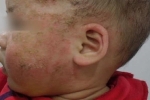 Trị viêm da cơ địa bằng tắm lá, bé 8 tháng tuổi biến chứng nặng