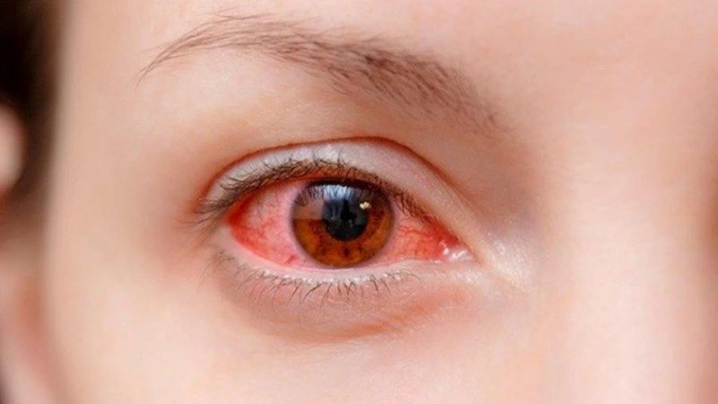 Sự kiện - Nhiều gia đình nghỉ học, nghỉ làm vì đau mắt đỏ, Bộ Y tế khuyến cáo 5 biện pháp