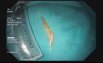 Sức khỏe - Đồng Nai: Gắp xương cá dài 4cm ra khỏi dạ dày bệnh nhân (Hình 3).