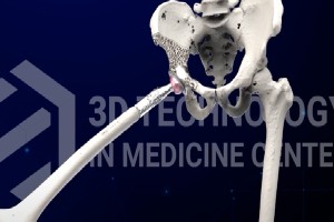 Bác sĩ tự thiết kế xương nhân tạo cứu bệnh nhân ung thư xương
