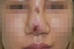 Nữ du học sinh hỏng mũi do phẫu thuật thẩm mỹ, bơm chất làm đẹp