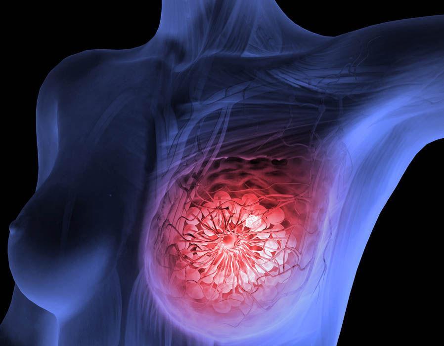 Phái nữ thức khuya có nguy cơ mắc bệnh ung thư vú cao gấp 3 lần người thường.